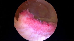 Inflammed Knee Synovium