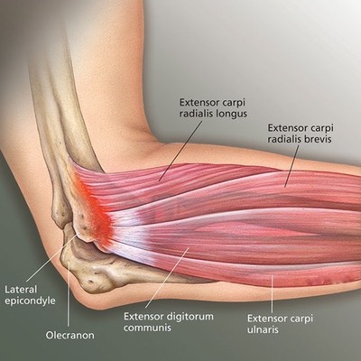 JMM lateral epicondylitis tennis elbow
