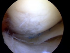 Knee Early Arthritis