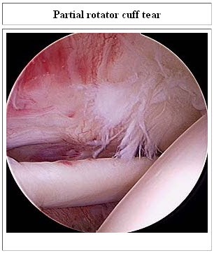 partial rotator cuff tear arthro