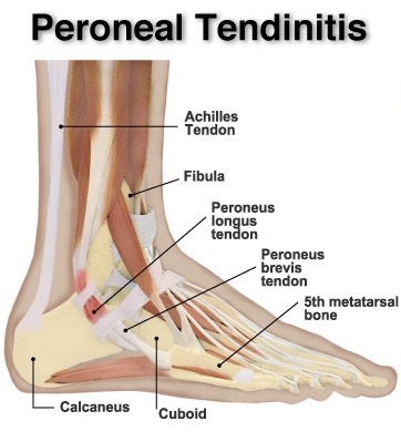 peroneal-tendinitis-tendonitis