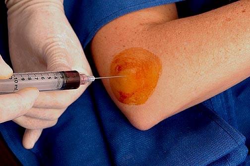 PRP-Injection LateralEpicondylitis