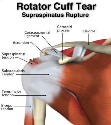 rotator-cuff-supraspinatus-tendon-tear (1)