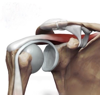 shoulder impingement (1)