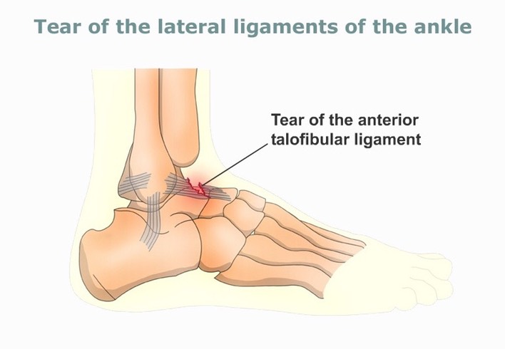 Tear-of-the-lateral-ligaments-of-the-ankle-web-large(800x600)